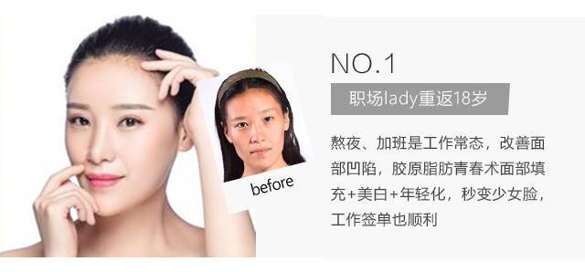 SVF胶原脂肪青春术