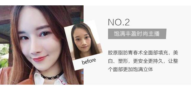 SVF胶原脂肪青春术