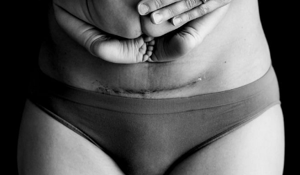 剖腹产疤痕痒怎么办