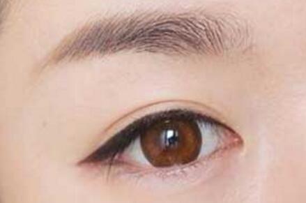 全切双眼皮可以割两次吗
