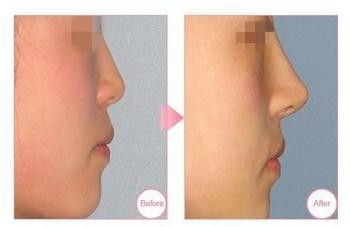 广州隆鼻哪个比较好